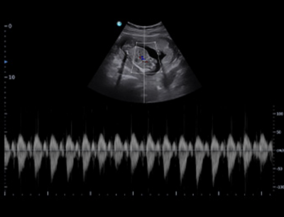 Chison SonoTouch 50 (SonoAir)