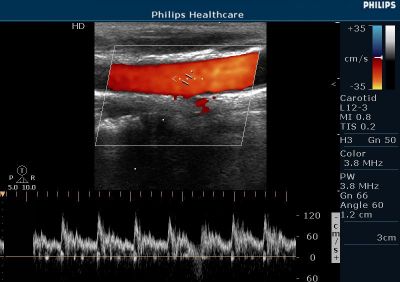 Philips HD5