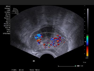 Siemens Acuson NX3 Elite