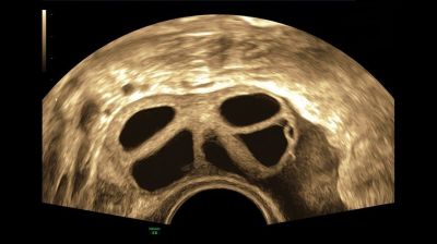 GE Healthcare Voluson E6