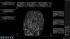 GE Healthcare Invenia Abus