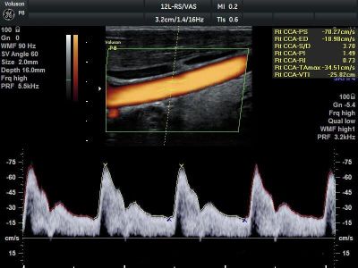 GE Healthcare Voluson P8