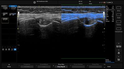 GE Healthcare Versana Balance