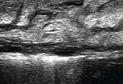 Acuvista Grace Scale